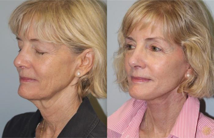 Before & After Face & Neck Lift Case 57 Left Oblique View in Newport Beach, CA