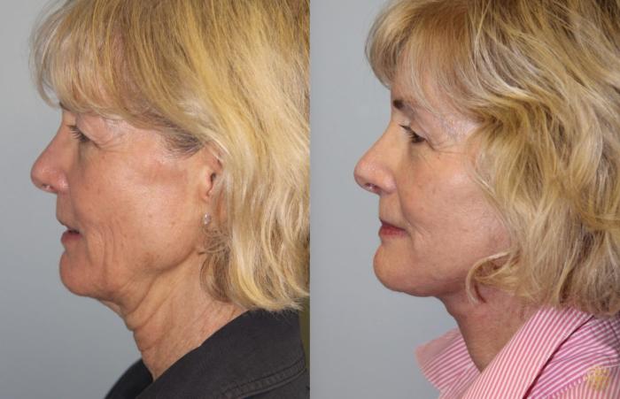 Before & After Face & Neck Lift Case 57 Left Side View in Newport Beach, CA