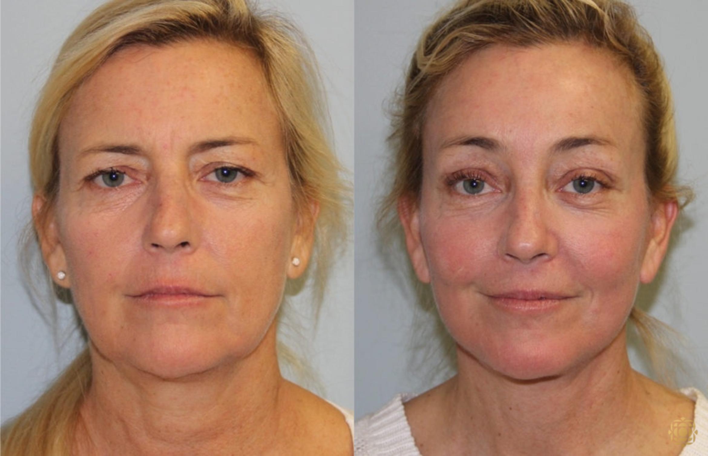 Before & After Face & Neck Lift Case 60 Front View in Newport Beach, CA