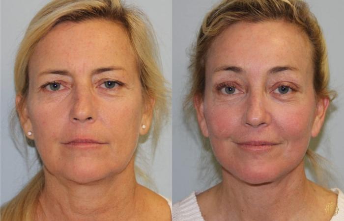 Before & After Face & Neck Lift Case 60 Front View in Newport Beach, CA