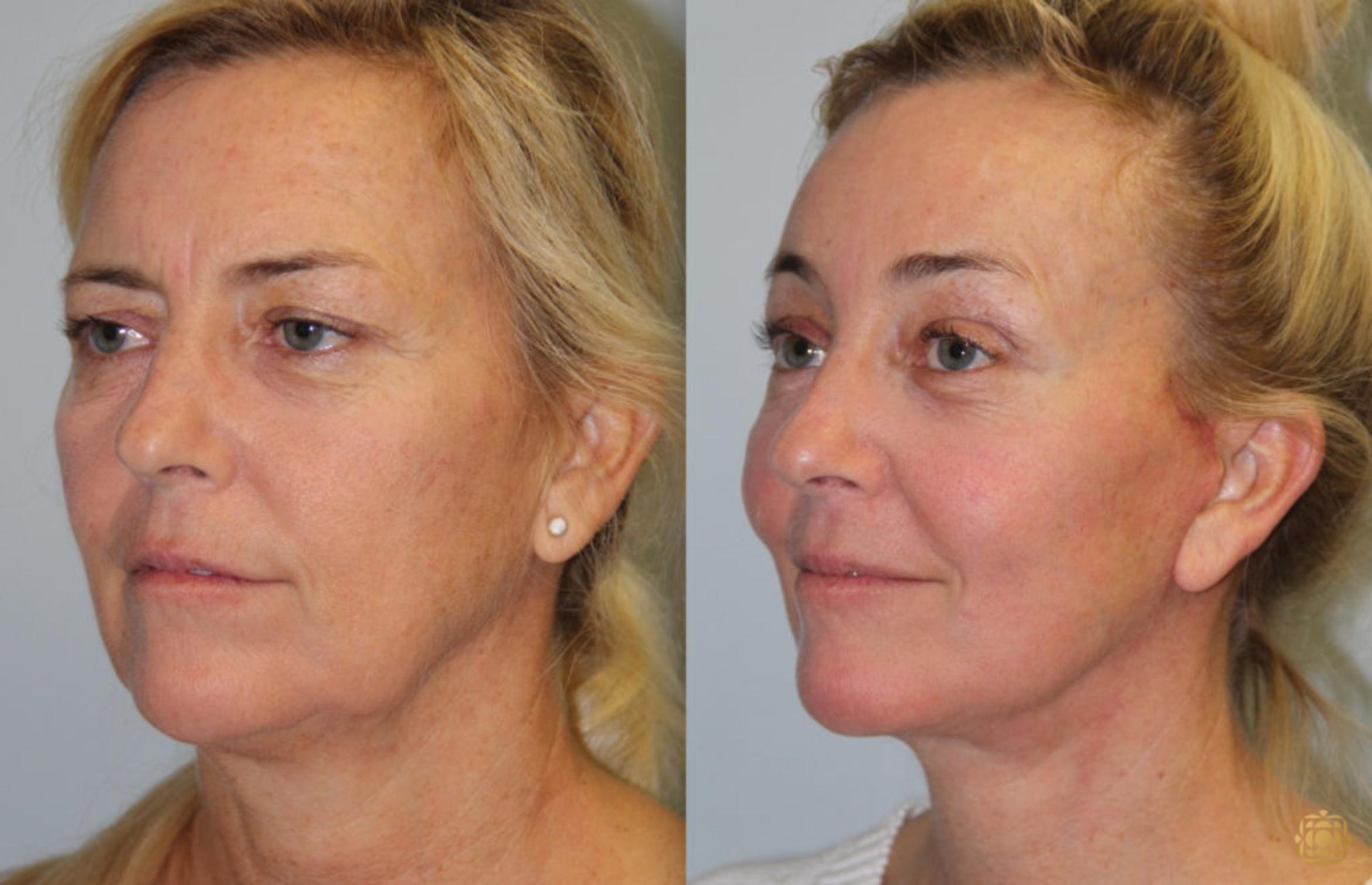Before & After Face & Neck Lift Case 60 Left Oblique View in Newport Beach, CA