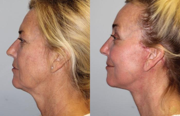 Before & After Face & Neck Lift Case 60 Left Side View in Newport Beach, CA