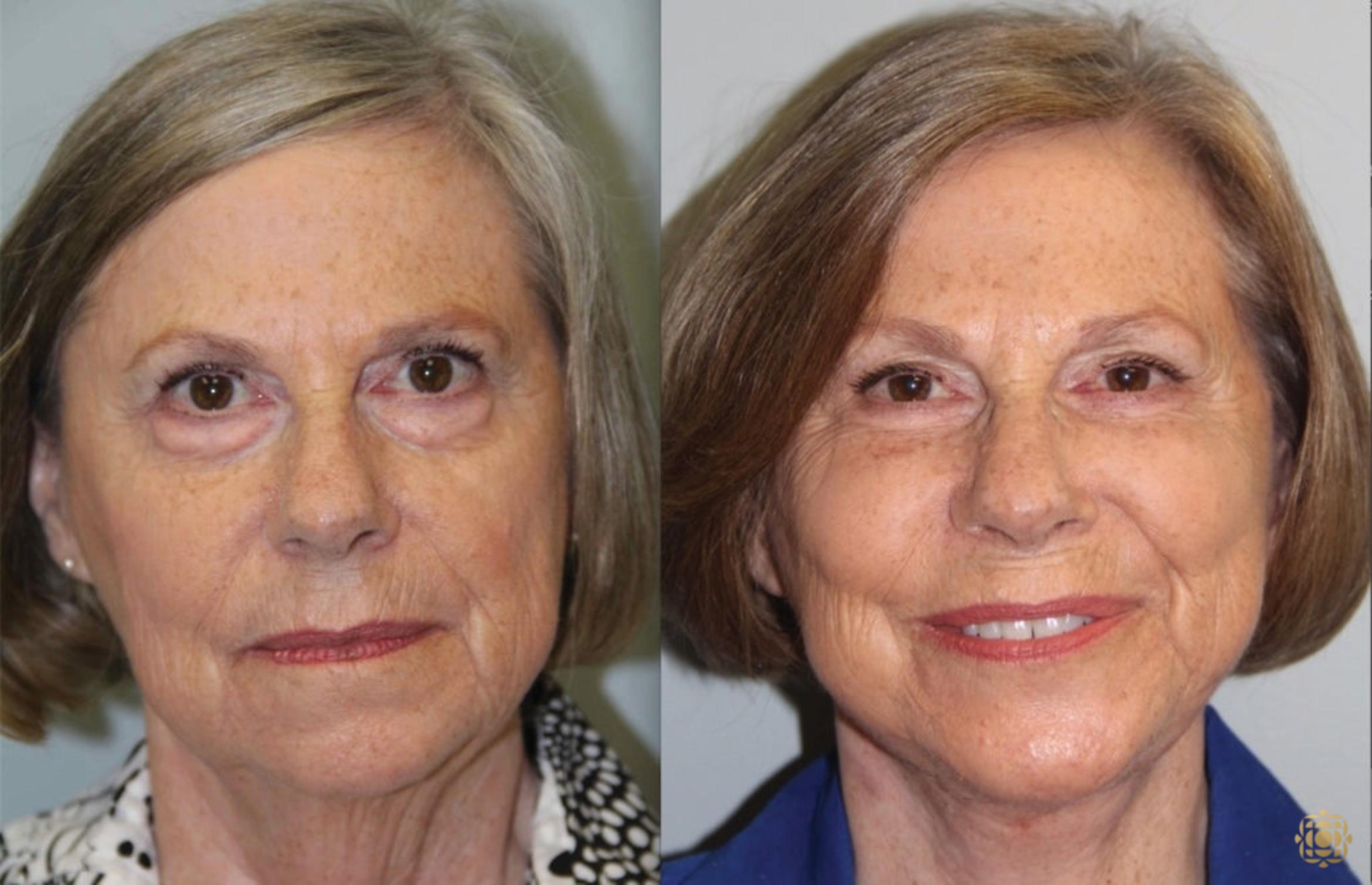 Before & After Face & Neck Lift Case 63 Front View in Newport Beach, CA
