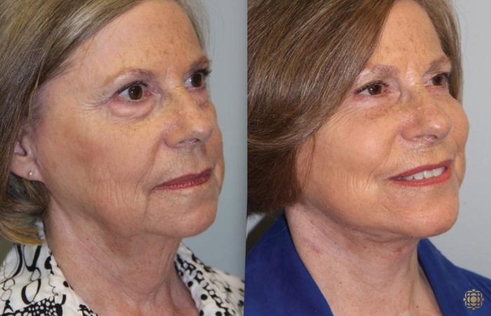 Before & After Face & Neck Lift Case 63 Right Oblique View in Newport Beach, CA