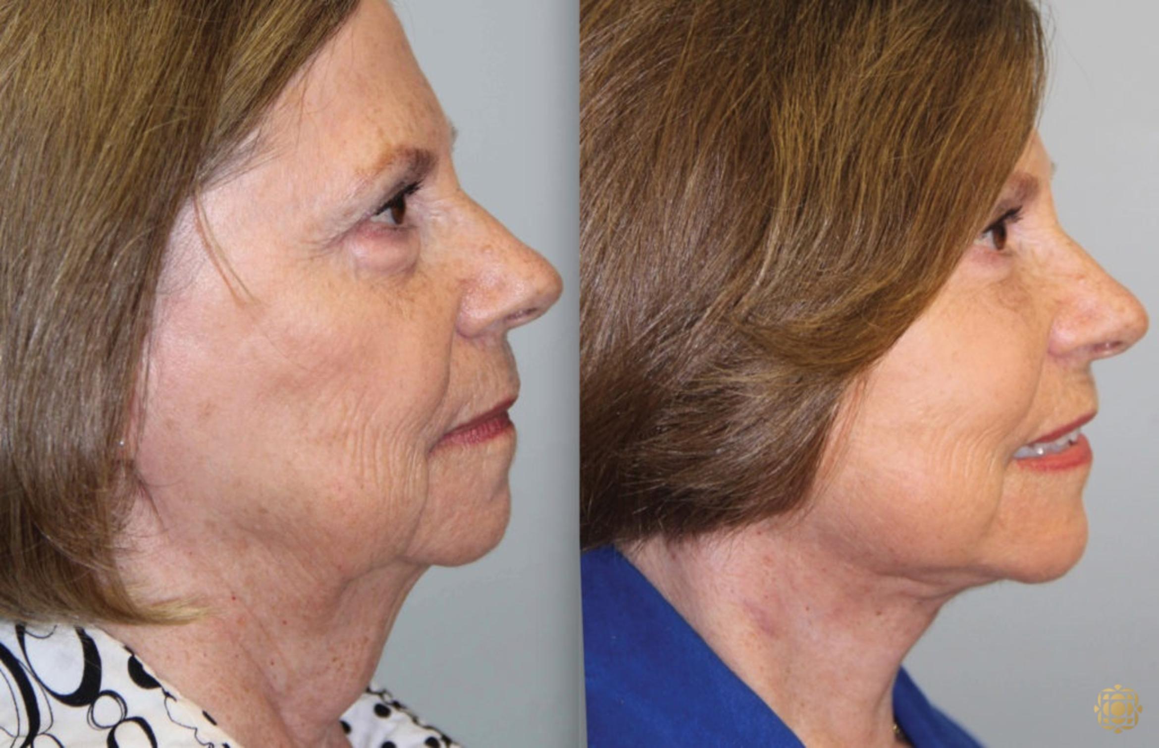 Before & After Face & Neck Lift Case 63 Right Side View in Newport Beach, CA