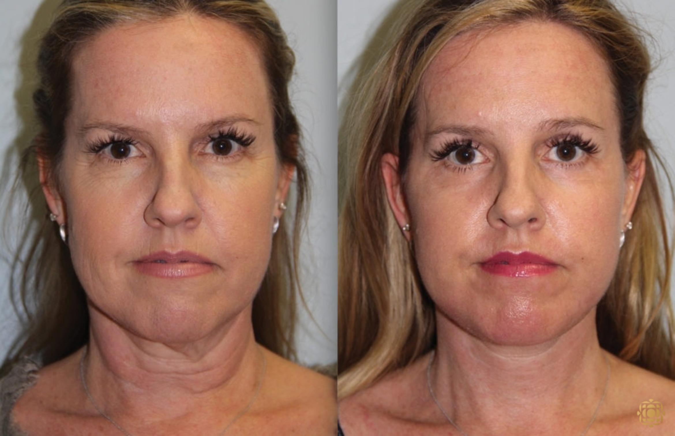 Before & After Fractional CO2 Laser Skin Resurfacing Case 66 Front View in Newport Beach, CA
