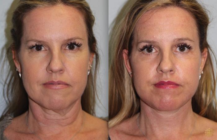 Before & After Fractional CO2 Laser Skin Resurfacing Case 66 Front View in Newport Beach, CA