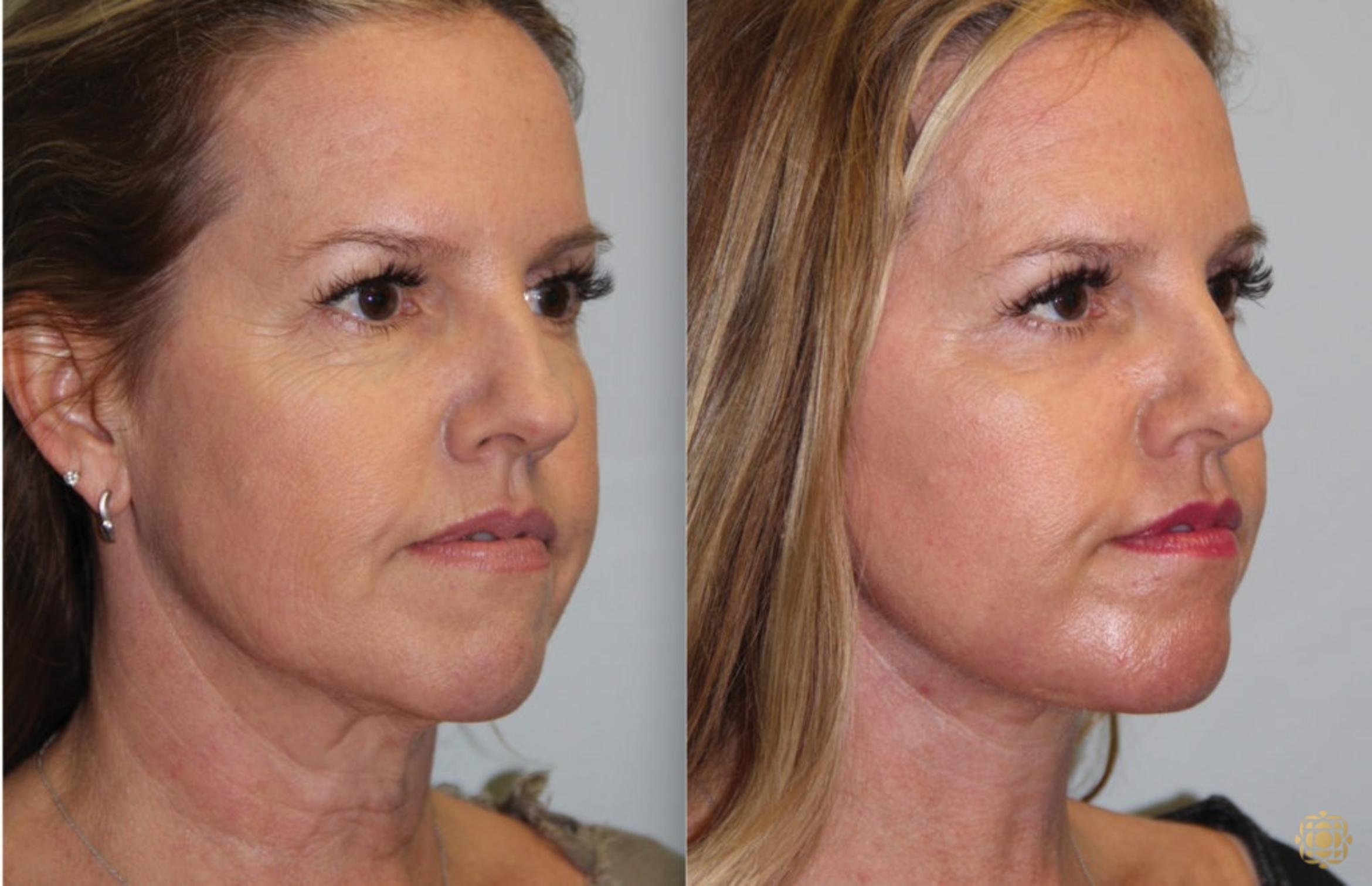 Before & After Fractional CO2 Laser Skin Resurfacing Case 66 Right Oblique View in Newport Beach, CA
