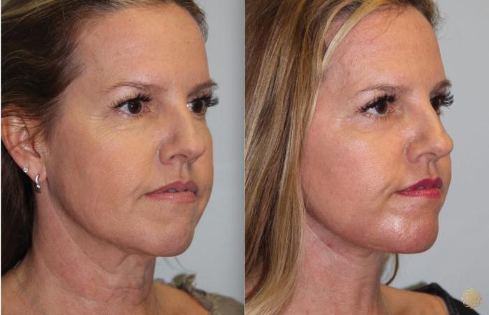 Before & After Fractional CO2 Laser Skin Resurfacing Case 66 Right Oblique View in Newport Beach, CA