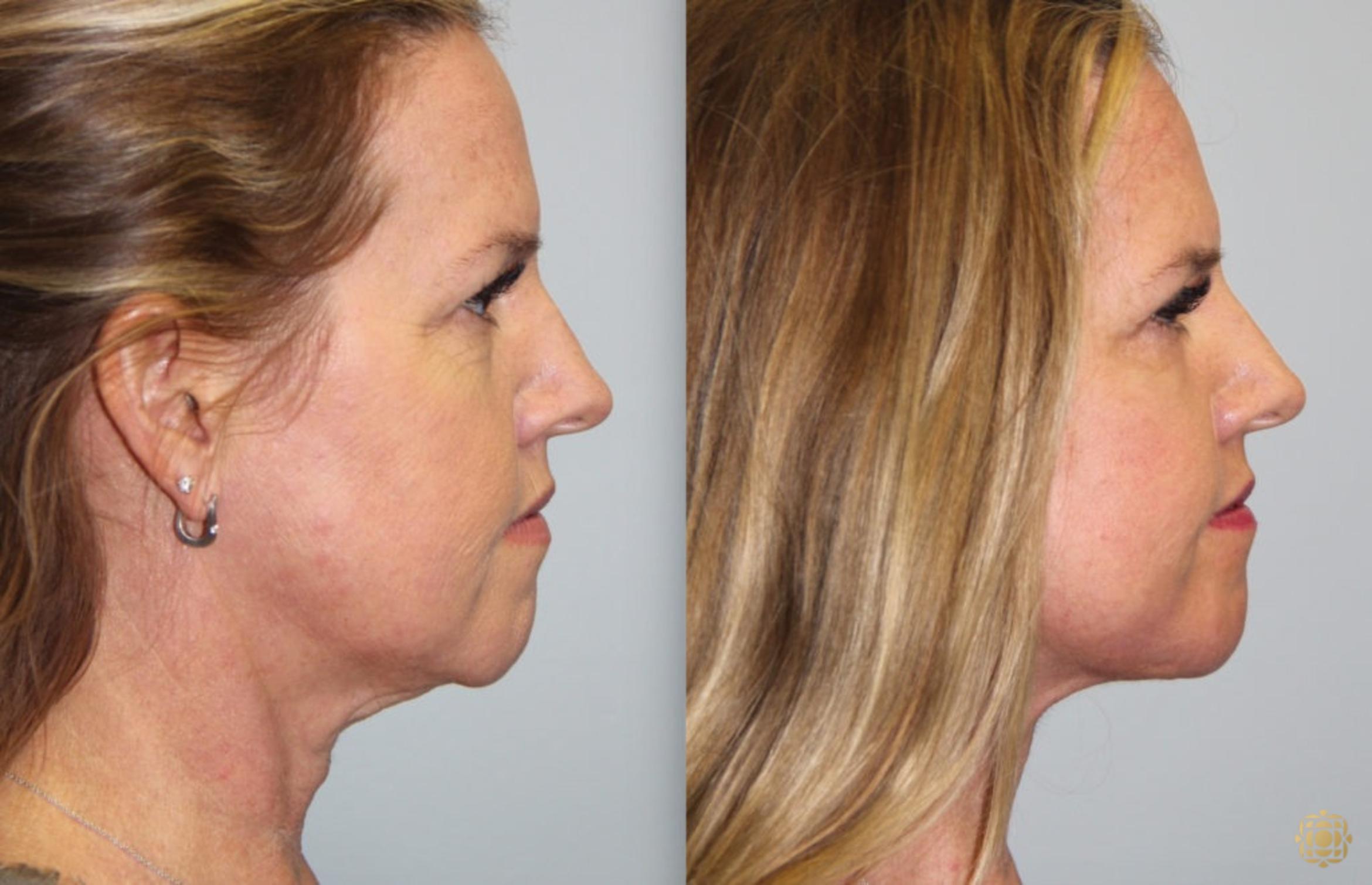 Before & After Fractional CO2 Laser Skin Resurfacing Case 66 Right Side View in Newport Beach, CA