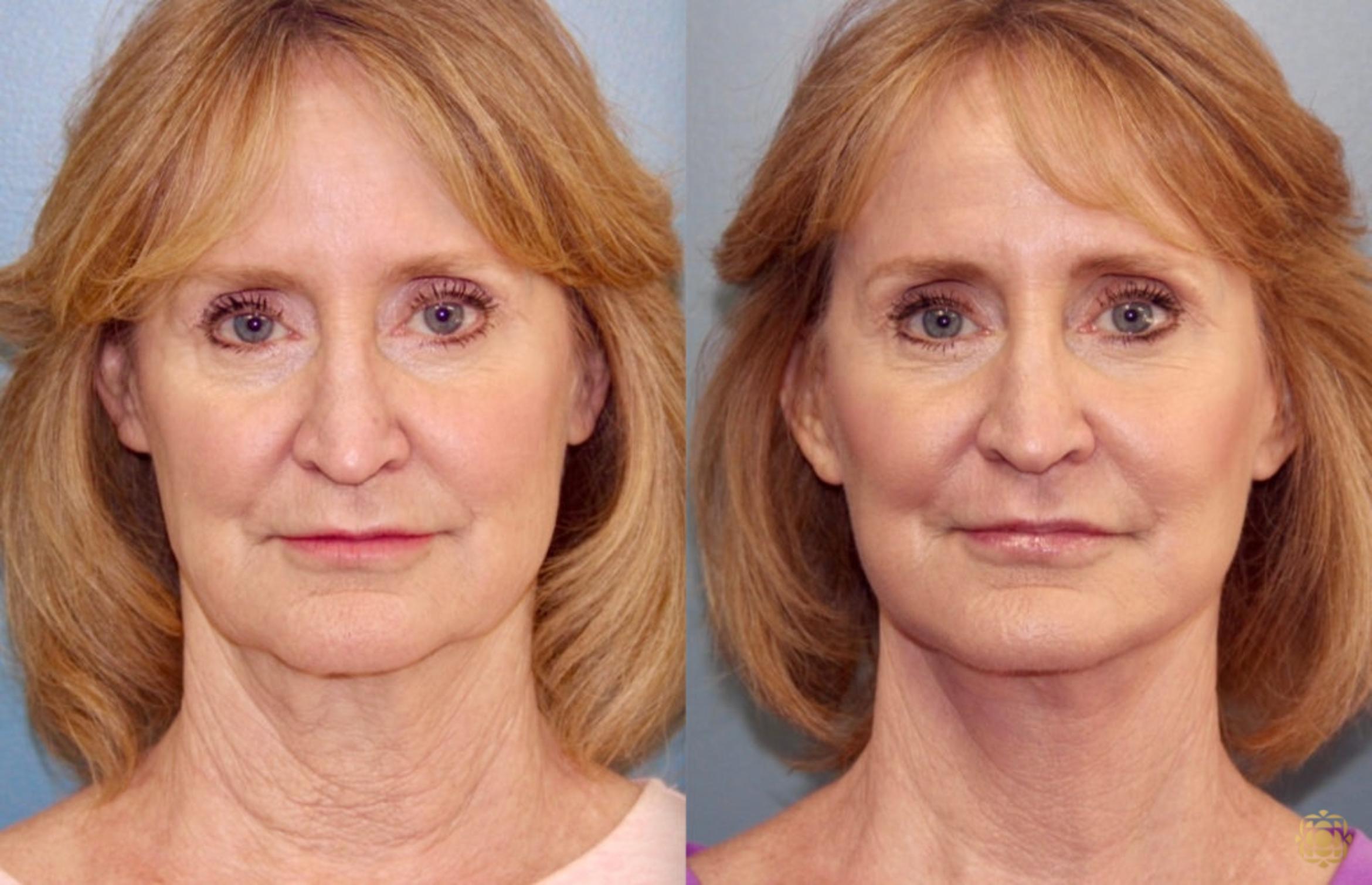 Before & After Face & Neck Lift Case 69 Front View in Newport Beach, CA
