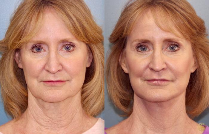 Before & After Face & Neck Lift Case 69 Front View in Newport Beach, CA