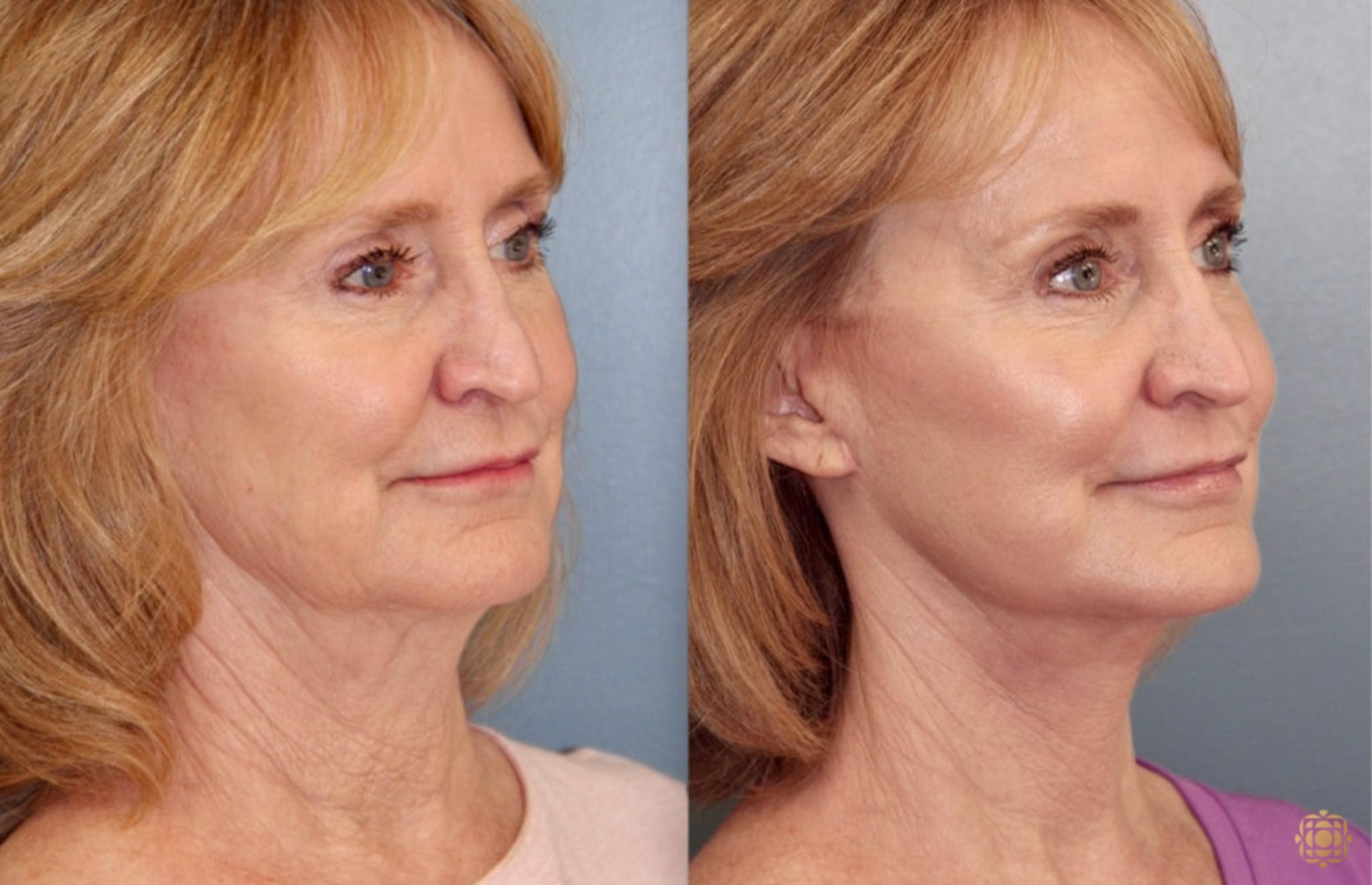 Before & After Face & Neck Lift Case 69 Right Oblique View in Newport Beach, CA
