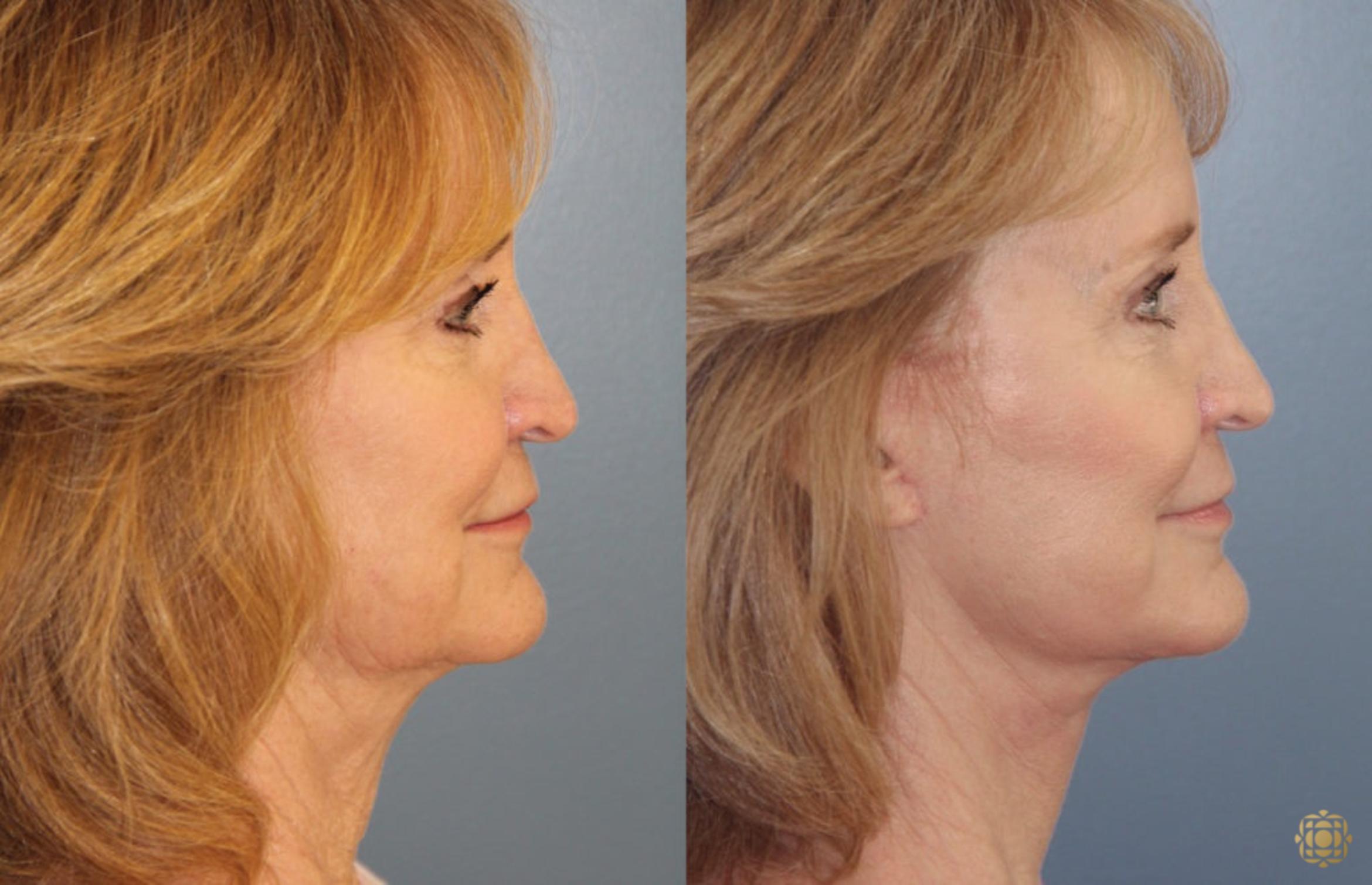 Before & After Face & Neck Lift Case 69 Right Side View in Newport Beach, CA