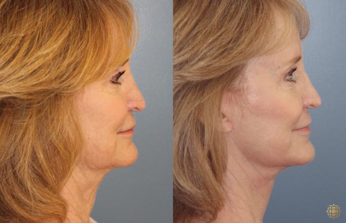 Before & After Face & Neck Lift Case 69 Right Side View in Newport Beach, CA