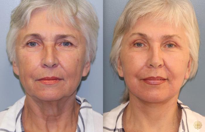 Before & After Face & Neck Lift Case 72 Front View in Newport Beach, CA