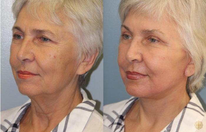 Before & After Face & Neck Lift Case 72 Left Oblique View in Newport Beach, CA