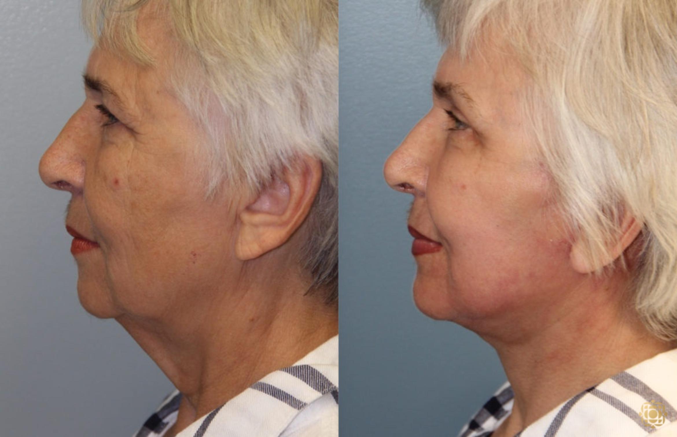 Before & After Face & Neck Lift Case 72 Left Side View in Newport Beach, CA