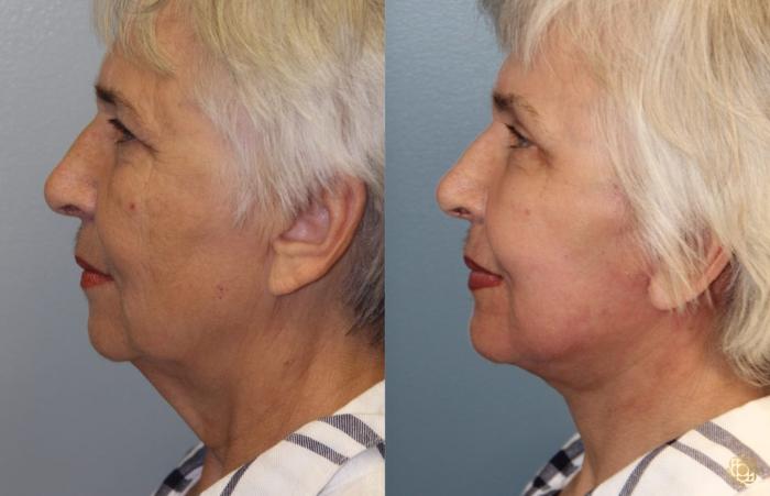 Before & After Face & Neck Lift Case 72 Left Side View in Newport Beach, CA