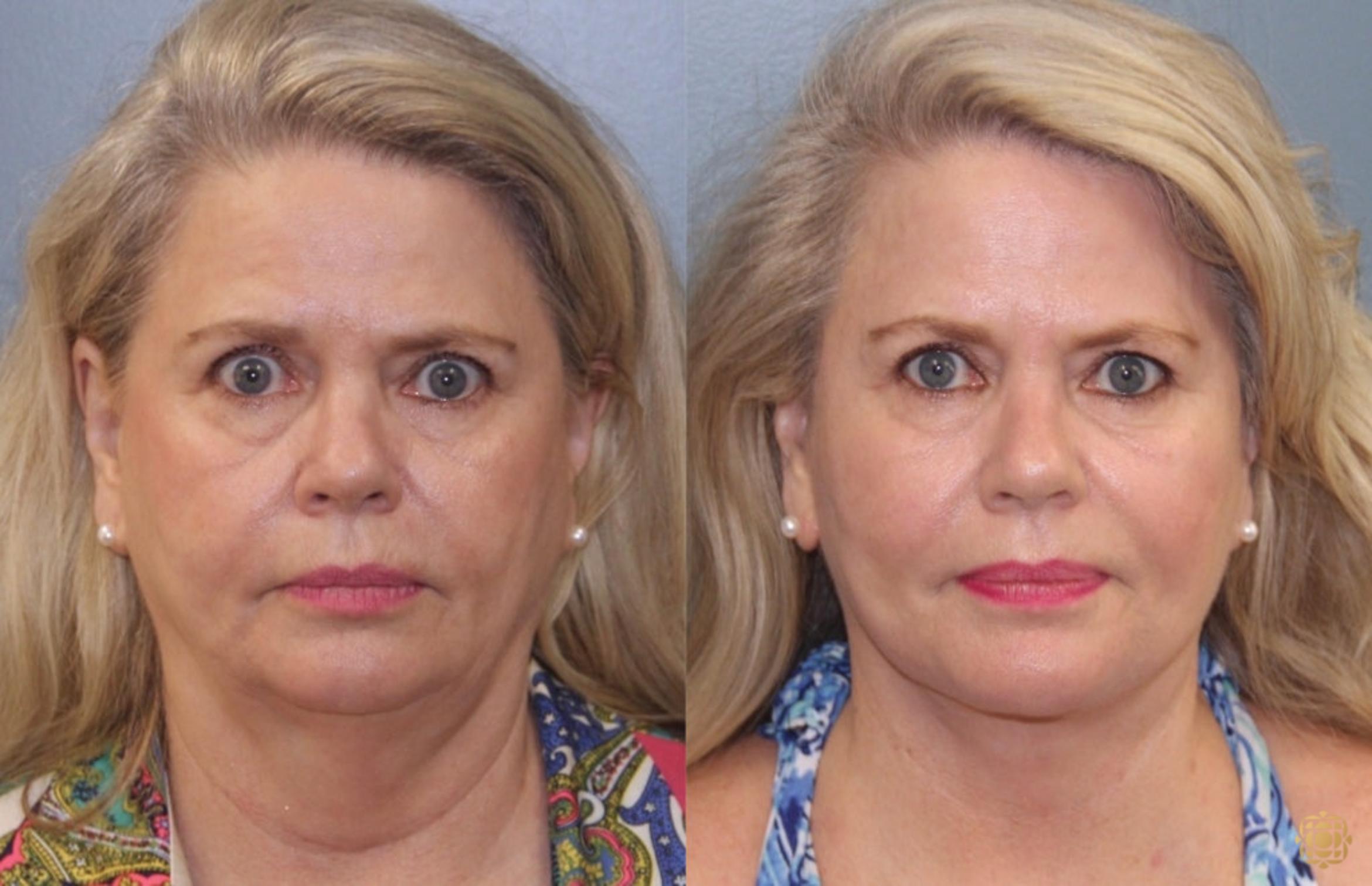 Before & After Face & Neck Lift Case 75 Front View in Newport Beach, CA