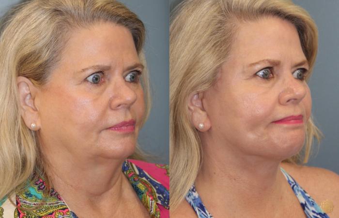 Before & After Face & Neck Lift Case 75 Right Oblique View in Newport Beach, CA