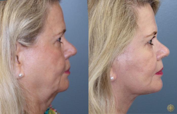 Before & After Face & Neck Lift Case 75 Right Side View in Newport Beach, CA