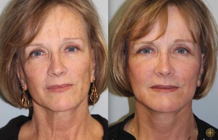 Before & After Face & Neck Lift Case 78 Front View in Newport Beach, CA