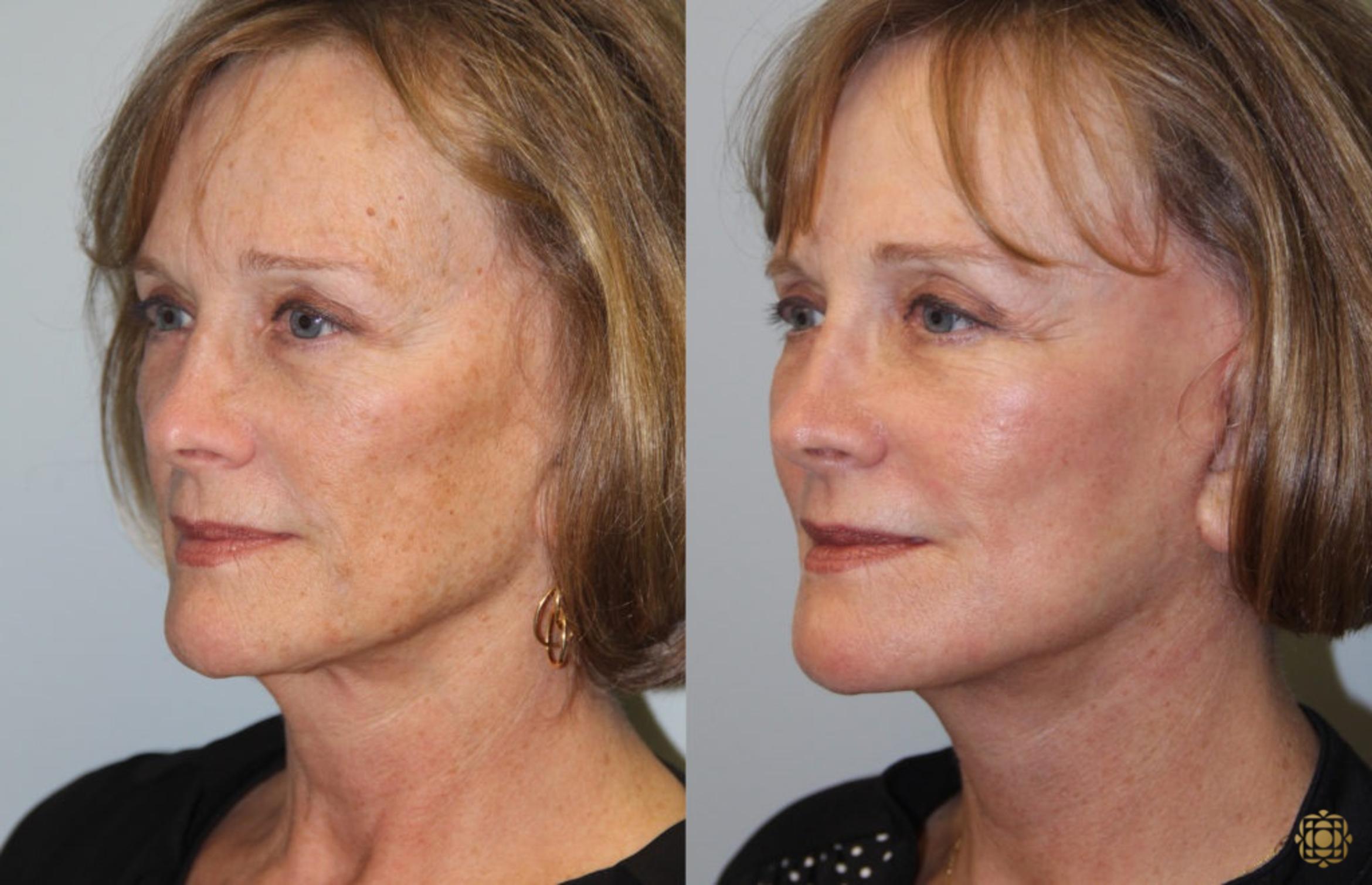Before & After Face & Neck Lift Case 78 Left Oblique View in Newport Beach, CA