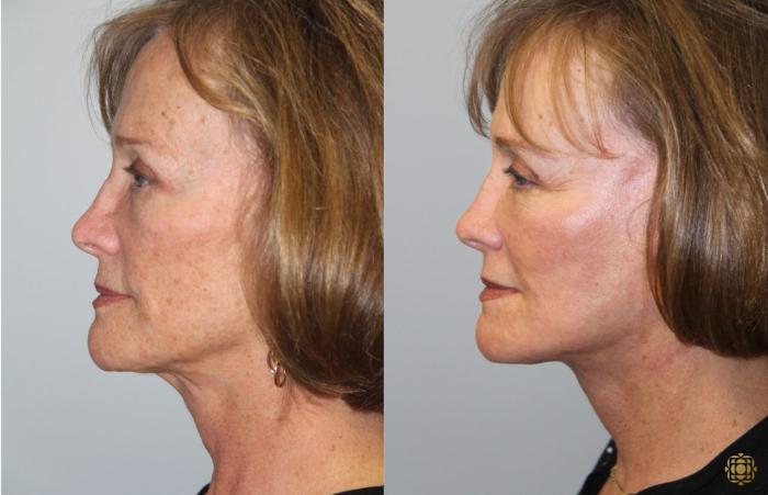 Before & After Face & Neck Lift Case 78 Left Side View in Newport Beach, CA