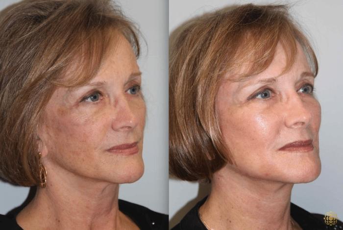 Before & After Face & Neck Lift Case 78 Right Oblique View in Newport Beach, CA