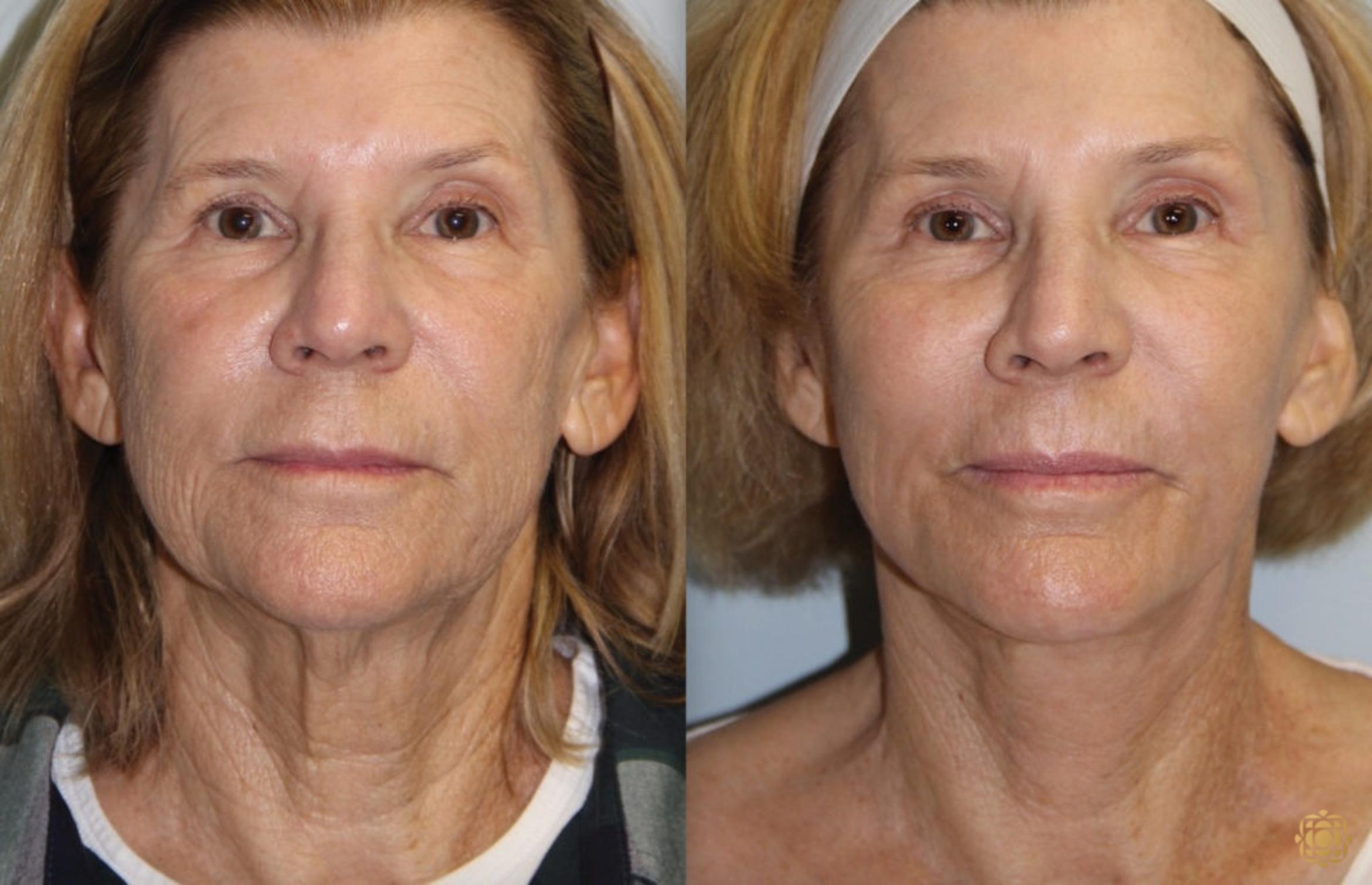 Before & After Face & Neck Lift Case 81 Front View in Newport Beach, CA