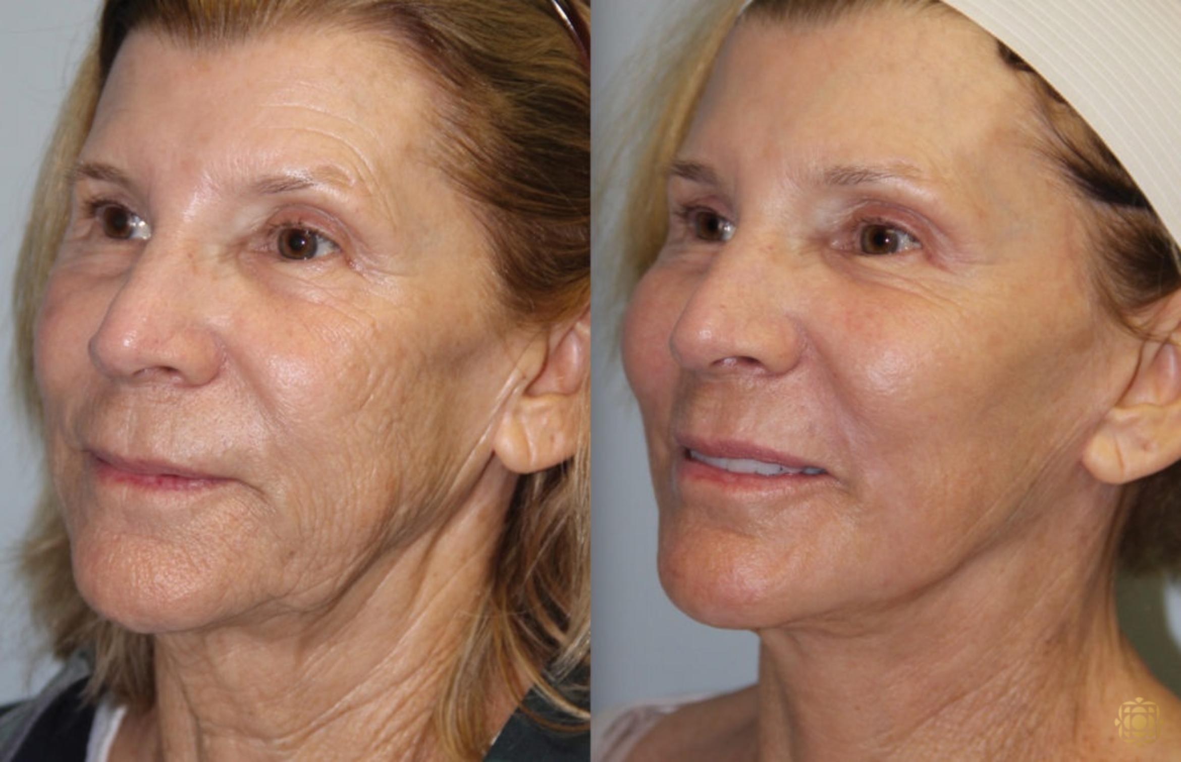 Before & After Face & Neck Lift Case 81 Right Oblique View in Newport Beach, CA