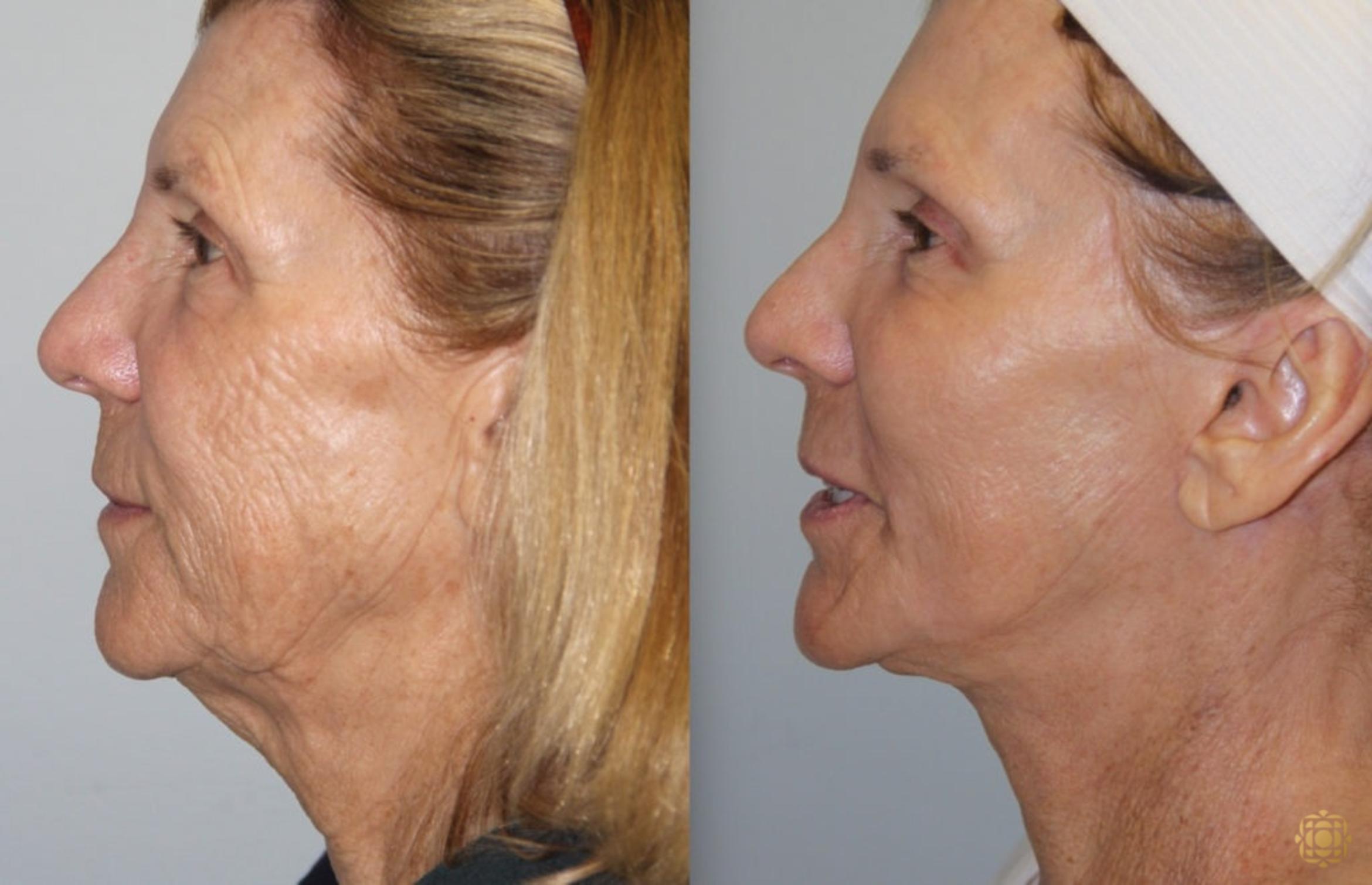 Before & After Face & Neck Lift Case 81 Right Side View in Newport Beach, CA
