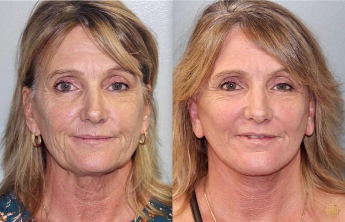 Before & After Face & Neck Lift Case 84 Front View in Newport Beach, CA