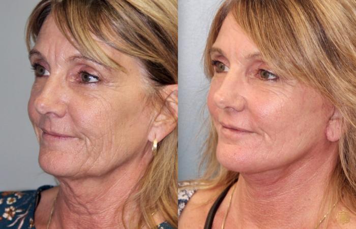 Before & After Face & Neck Lift Case 84 Left Oblique View in Newport Beach, CA