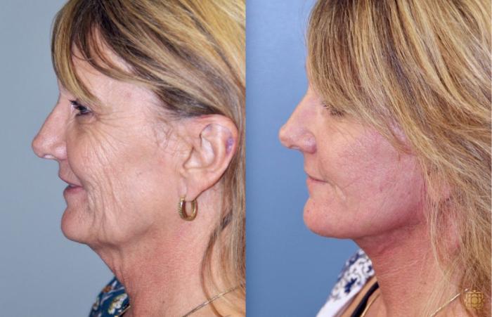 Before & After Face & Neck Lift Case 84 Left Side View in Newport Beach, CA