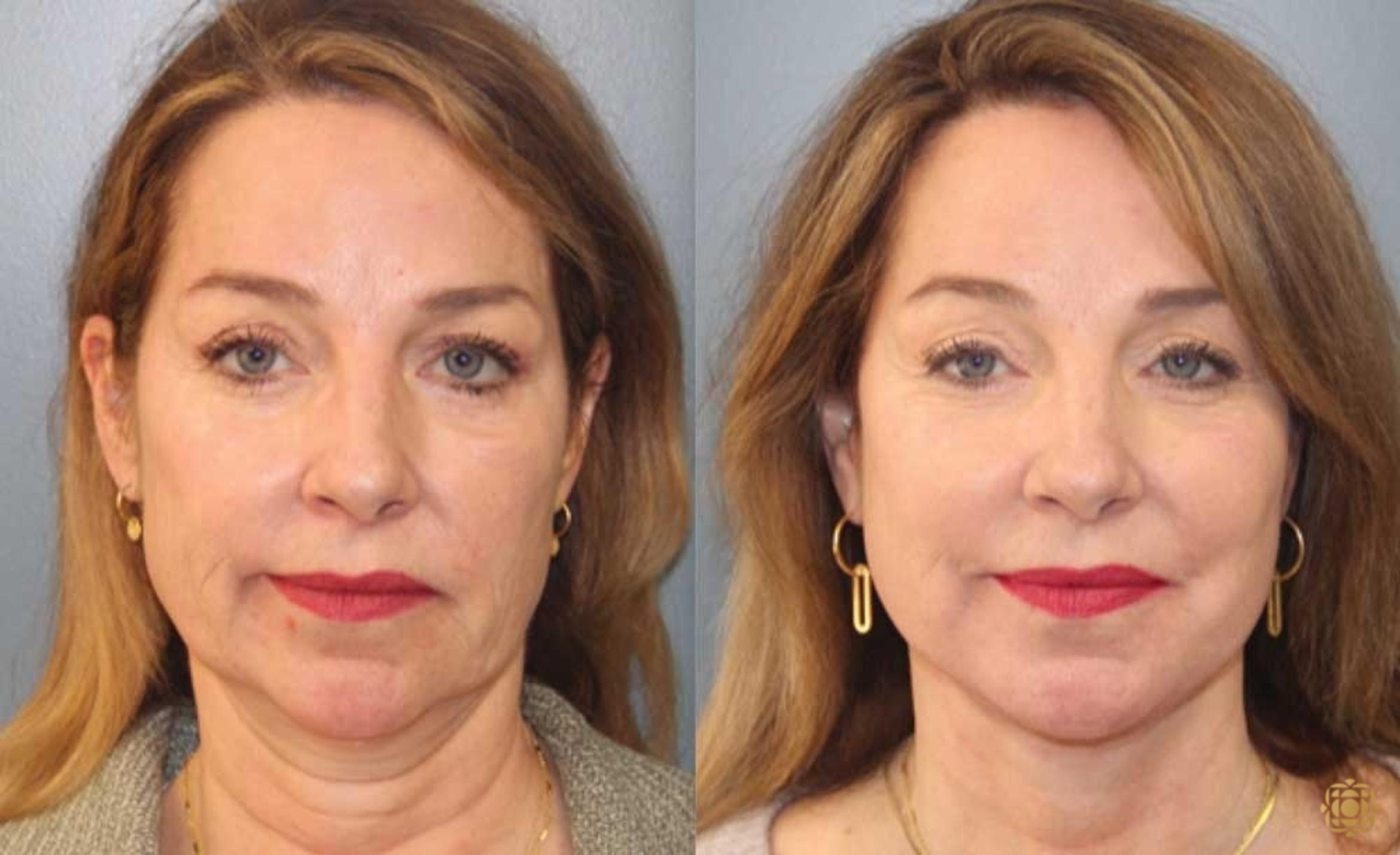 Before & After Face & Neck Lift Case 87 Front View in Newport Beach, CA