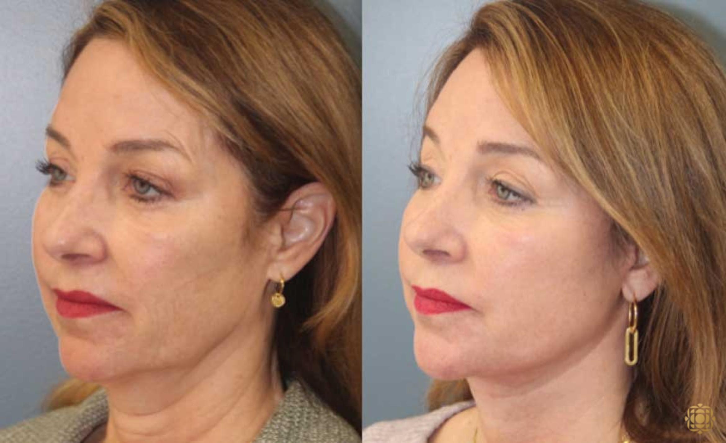 Before & After Face & Neck Lift Case 87 Left Oblique View in Newport Beach, CA