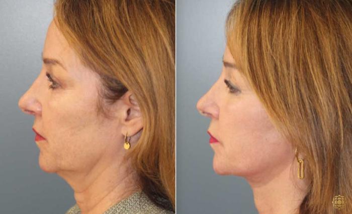 Before & After Face & Neck Lift Case 87 Left Side View in Newport Beach, CA