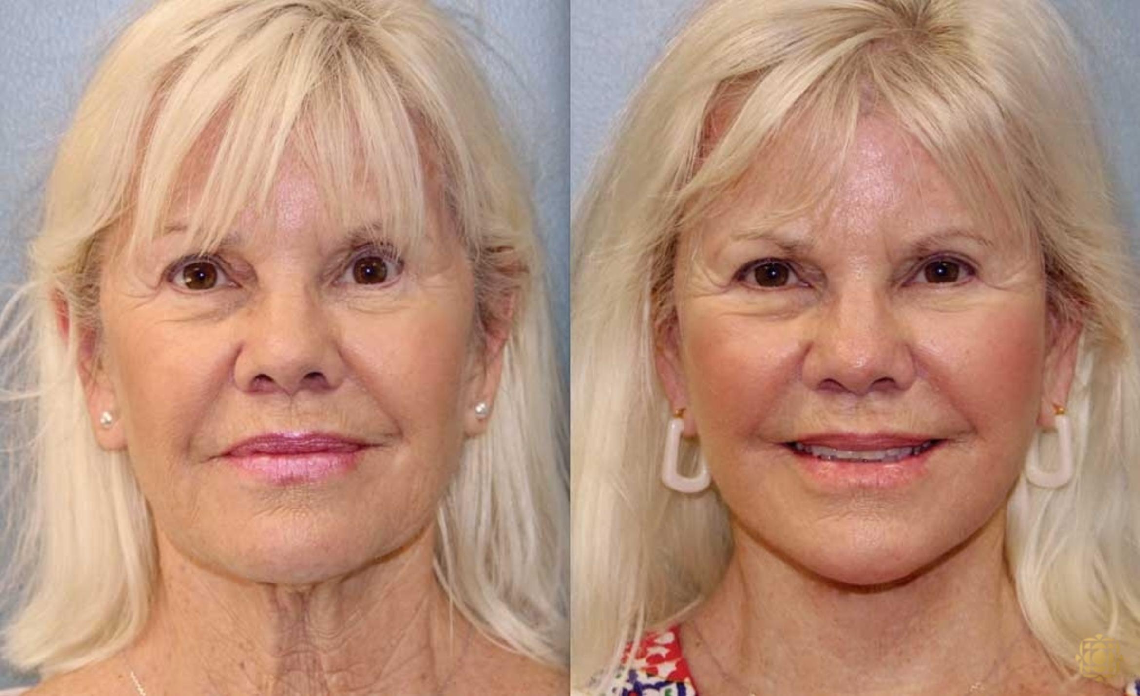Before & After Face & Neck Lift Case 90 Front View in Newport Beach, CA