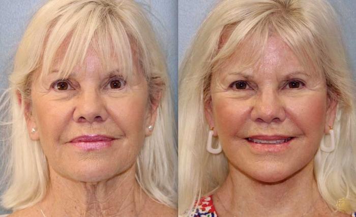 Before & After Face & Neck Lift Case 90 Front View in Newport Beach, CA