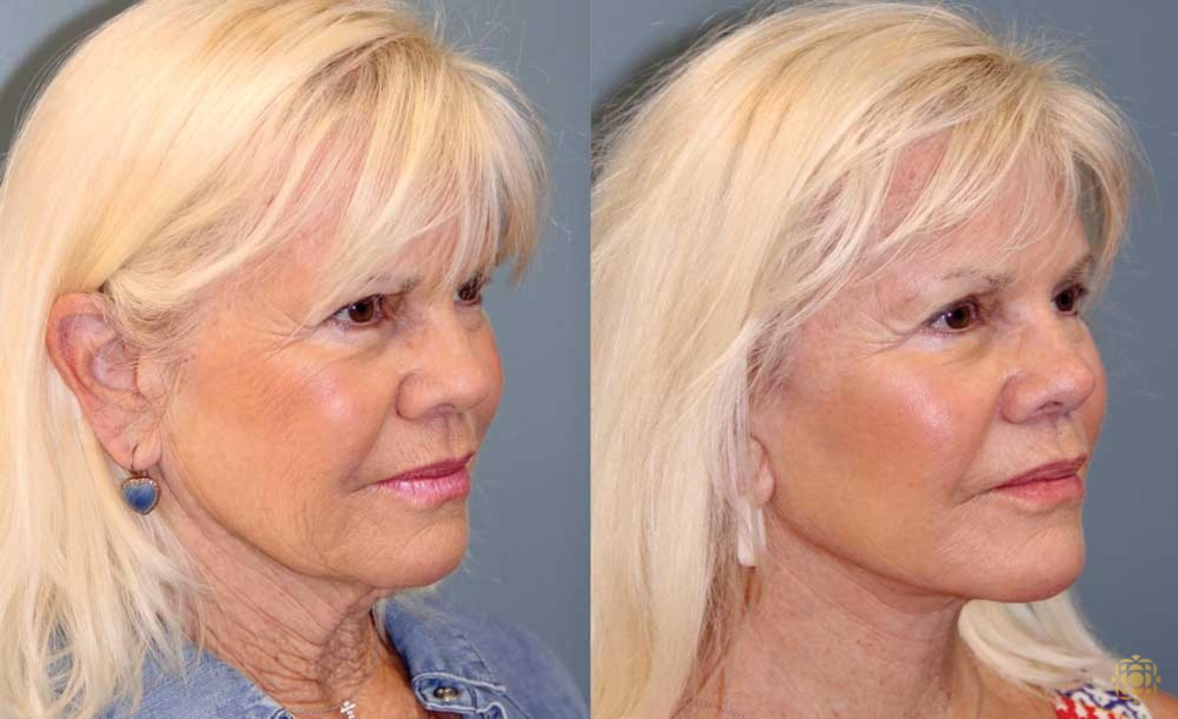 Before & After Face & Neck Lift Case 90 Right Oblique View in Newport Beach, CA