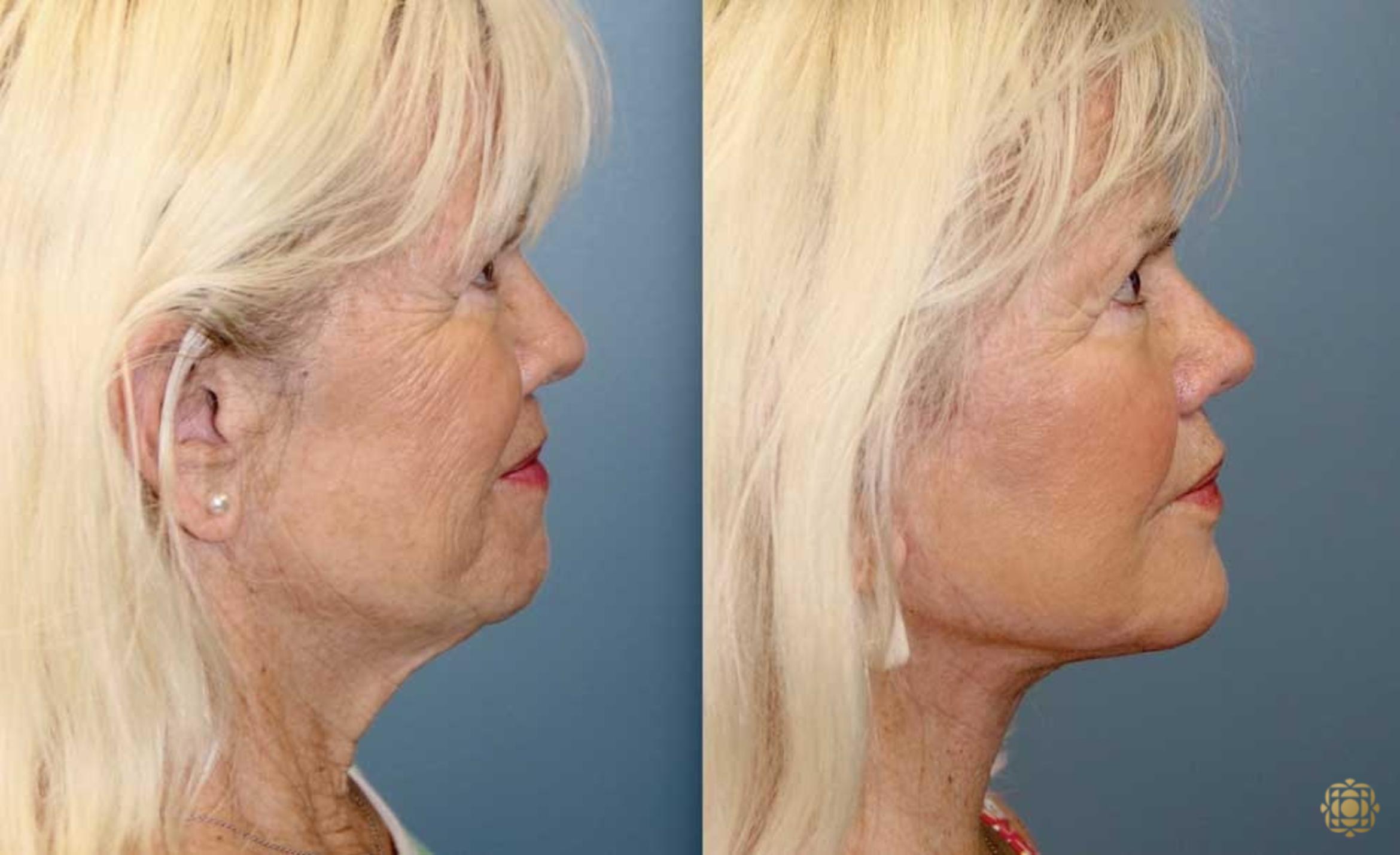 Before & After Face & Neck Lift Case 90 Right Side View in Newport Beach, CA