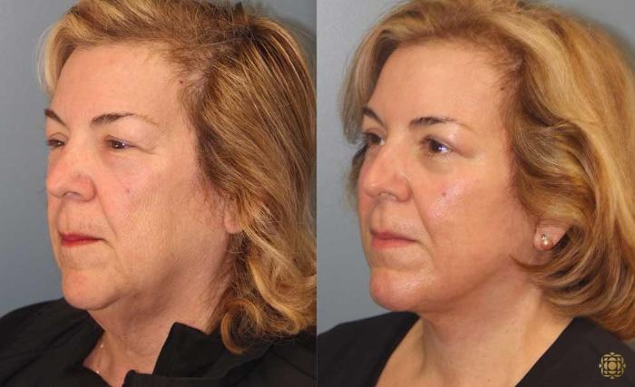 Before & After Fractional CO2 Laser Skin Resurfacing Case 93 Left Oblique View in Newport Beach, CA