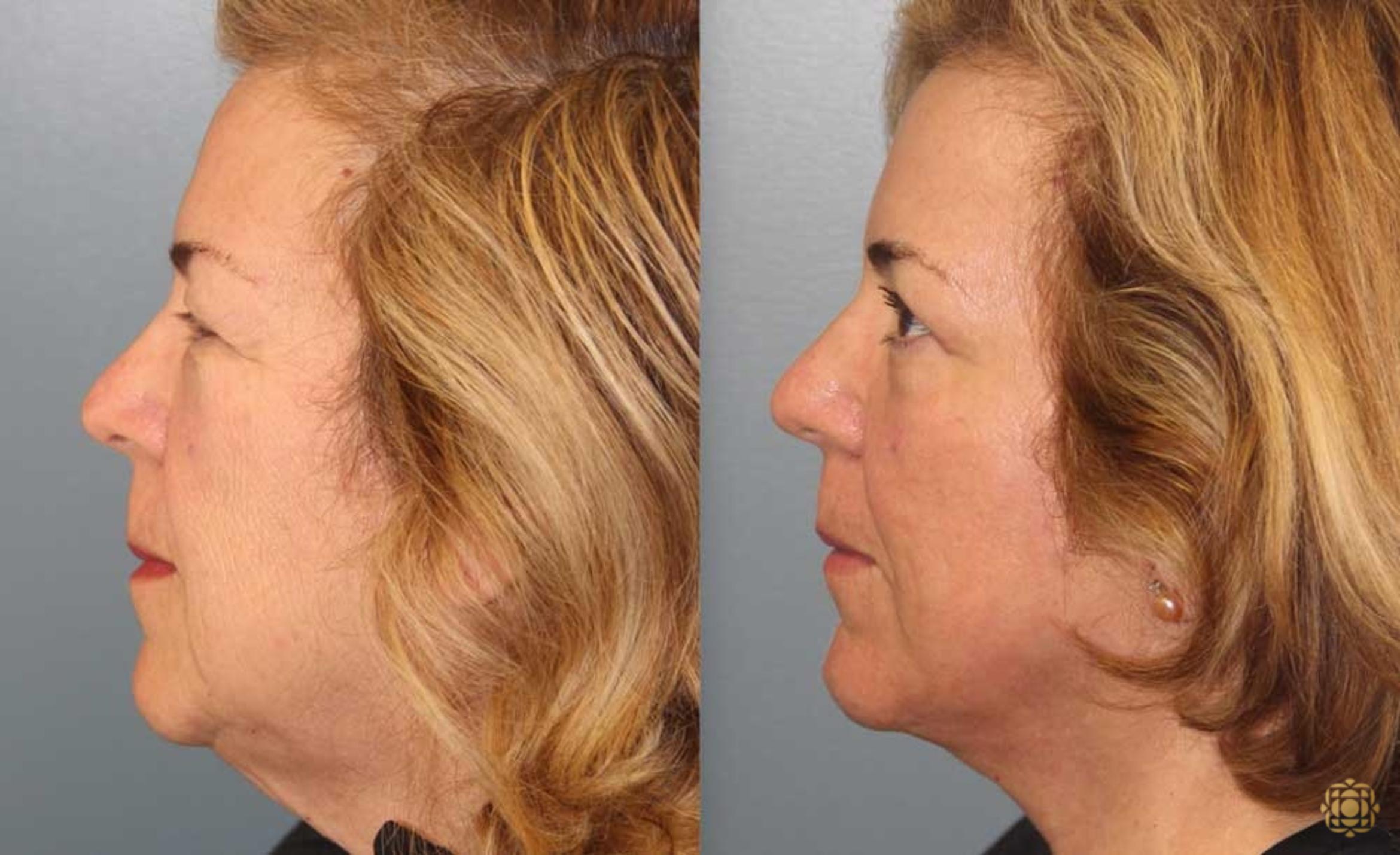 Before & After Fractional CO2 Laser Skin Resurfacing Case 93 Left Side View in Newport Beach, CA