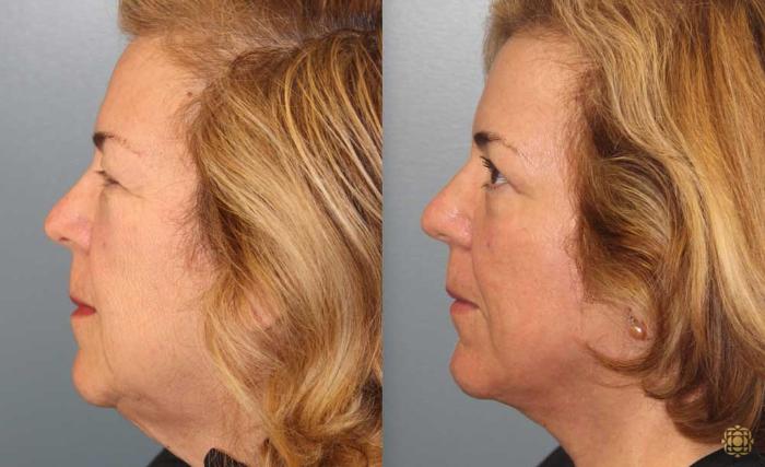 Before & After Fractional CO2 Laser Skin Resurfacing Case 93 Left Side View in Newport Beach, CA