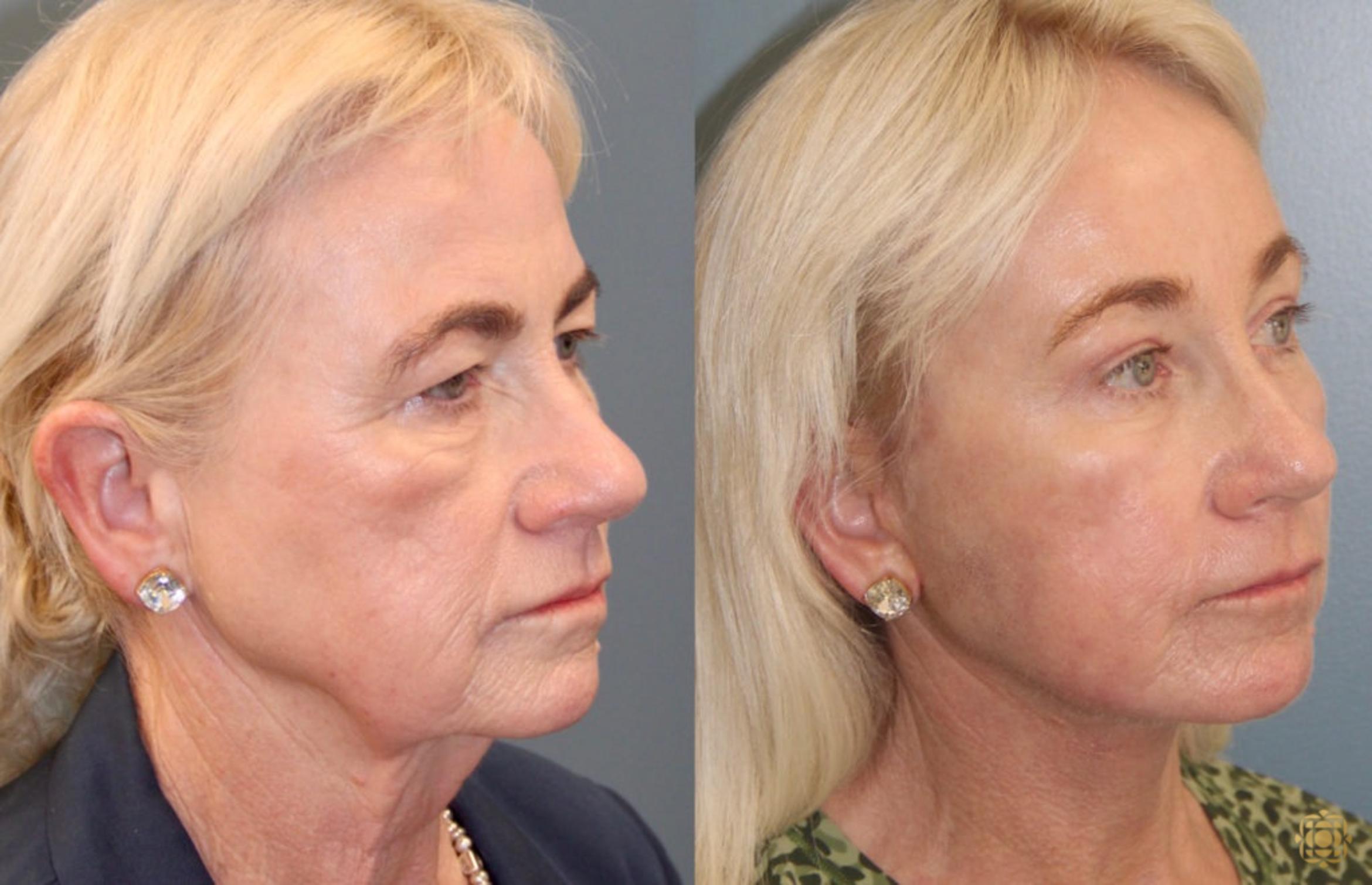 Before & After Fractional CO2 Laser Skin Resurfacing Case 96 Right Oblique View in Newport Beach, CA