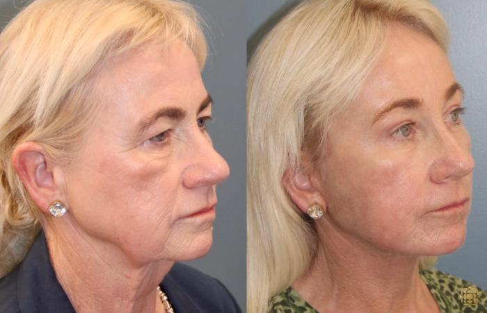 Before & After Fractional CO2 Laser Skin Resurfacing Case 96 Right Oblique View in Newport Beach, CA