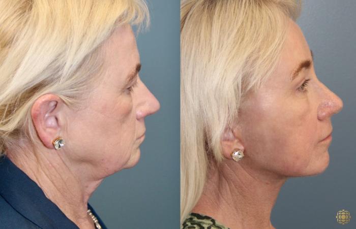 Before & After Fractional CO2 Laser Skin Resurfacing Case 96 Right Side View in Newport Beach, CA