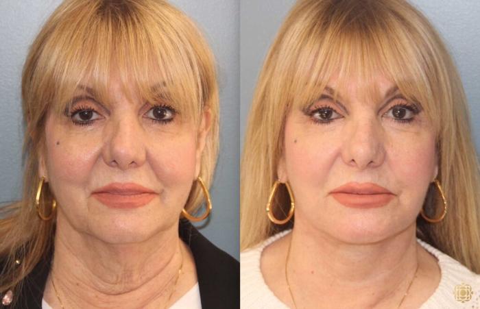 Before & After Face & Neck Lift Case 99 Front View in Newport Beach, CA